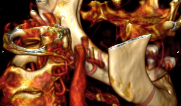Anatomic Models (3D): Skull and Neck
