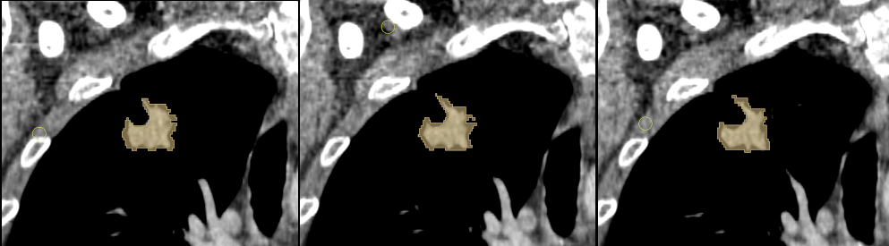 LIDC-IDRI Tumor Segmentation: Patient 0 / Panel Series