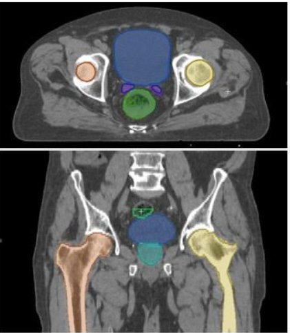 Microsoft InnerEye Automated Segmentation: Hip Segmentation Patient 3