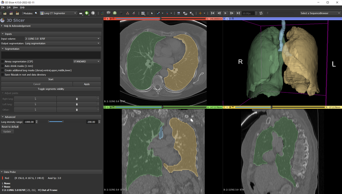 Sonador Imaging Platform: Lung Segmentation Step 2