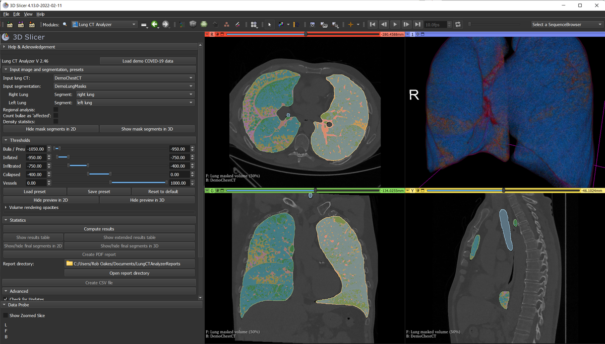 Sonador Imaging Platform: Automated Lung Analysis