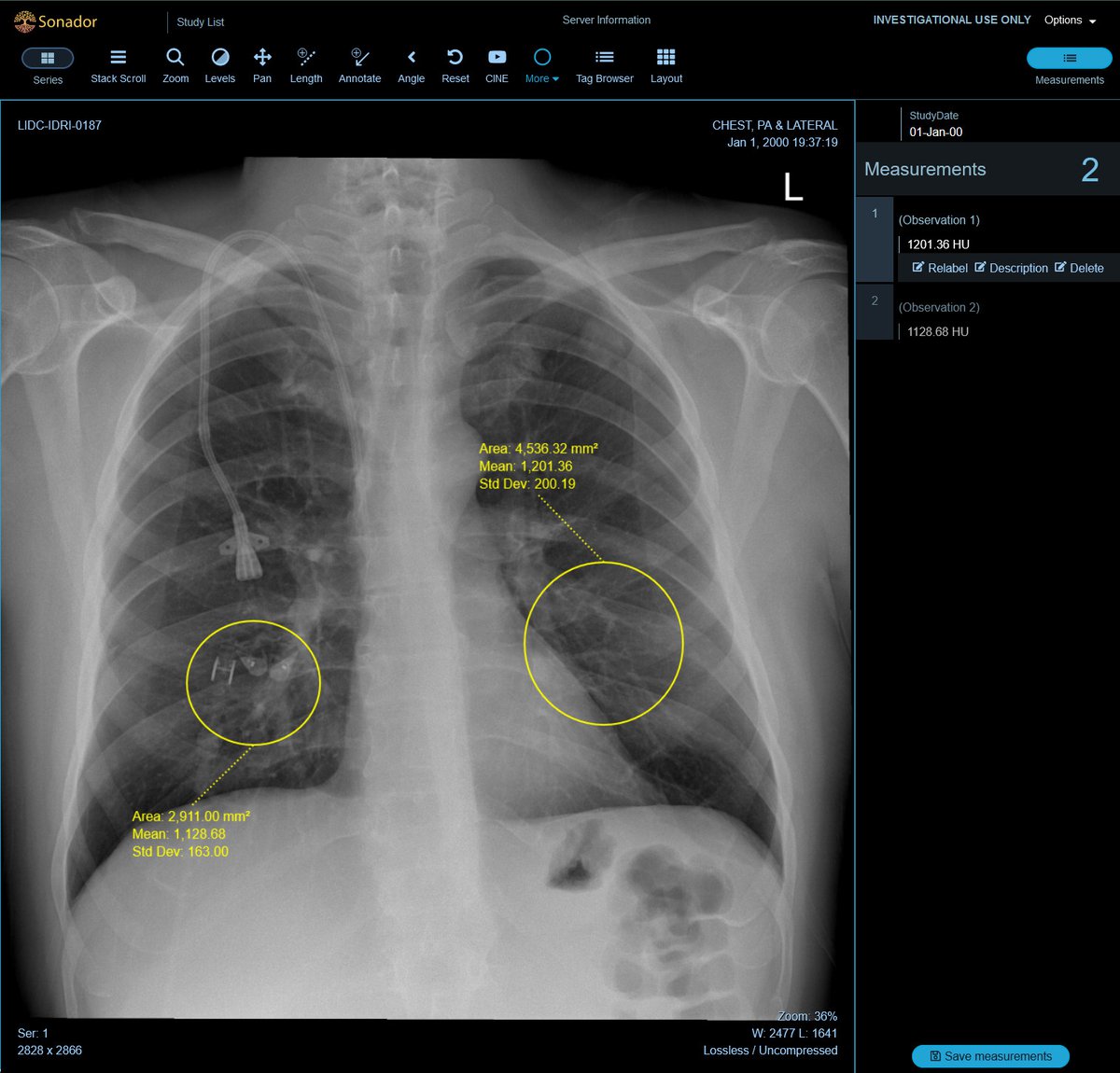 Sonador/OHIF: OHIF supports a broad set of annotation tools for acquiring measurements or specifying findings