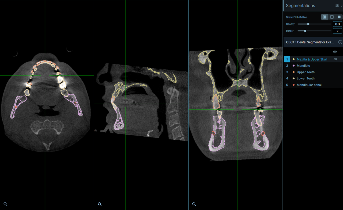 Sonador 0.4.1: Cornerstone3D Multi-planar Reconstruction