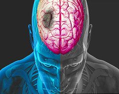 I Had A Stroke, Was Eating Jerky A Cause?